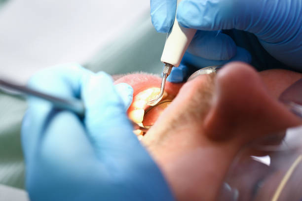 Best Emergency Dentist for Lost Fillings or Crowns in Rosebud, SD